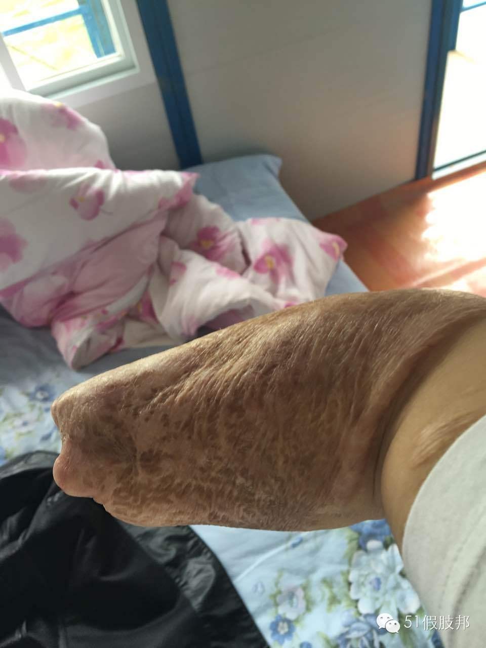 武汉李先生想要安装前臂假肢，假肢公司看到请与联系